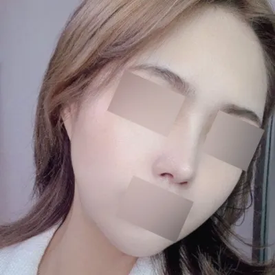 Өргөх + хамрын дахин мэс заслын дараах 4 сарын тойм