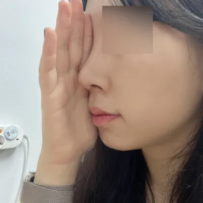 Хамрын мэс заслын 3 долоо хоногийн дараах сэтгэгдэл :)