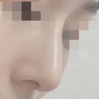 Имплантгүйгээр О Ён Со шиг гоё шулуун хамар гаргасан!