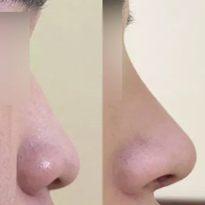 Унжсан, намхан хамартан дээр хийлгэсэн мэс заслын тойм