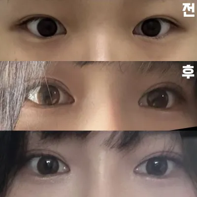 Үр дүнд нь маш их сэтгэл хангалуун байгаадаа маш их баяртай байна. Эмчдээ баярлалаа!!