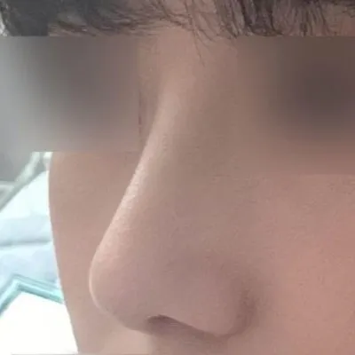 Анхны хамарны мэс засал хэдий ч маш их 3728299393829% сэтгэл хангалуун байна