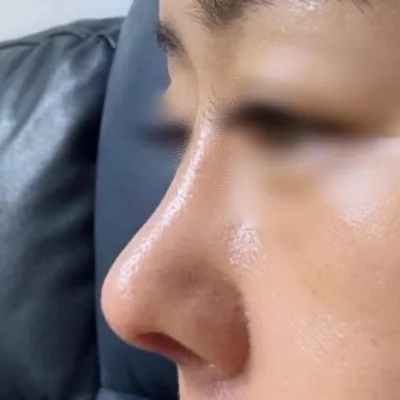 Хамрын үзүүр доошоо унждаг байсан нь санаа зовоож байсан ч хамрын үзүүртэй болсондоо маш их баяртай байна ^^