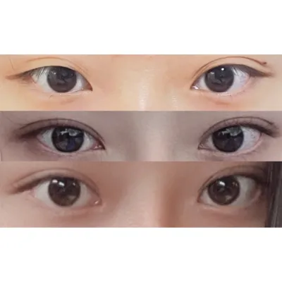 Нүд, хамраа хамт мэс засалд оруулсан шүүㅎㅎ