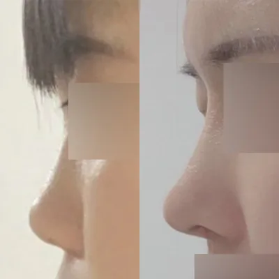 Нүд, хамрын мэс засал хийлгэснээс хойш 8 сар болжээ!