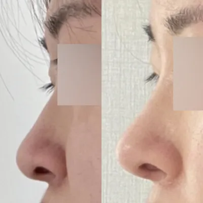 Удаан хугацаанд намайг зовоож байсан хамараа эцэст нь мэс засалд орууллаа ~