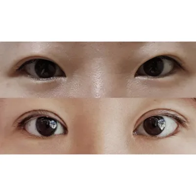 Нүдний хагалгаанд ороод сар гаруй боллоо