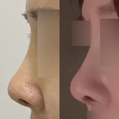 Би 5 жилийн өмнө гэнэт хамарны хагалгаанд орсон:-)))