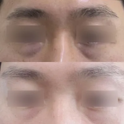 Нүдний доорх өөх тосыг дахин байрлуулсны дараах 2 сарын тойм :)