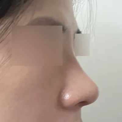 Бөмбөг хэлбэртэй хамрын мэс засал хийлгэсэн