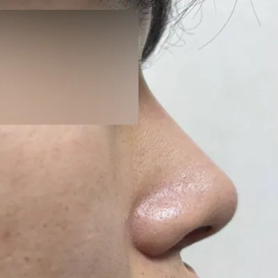 Шим эмчийн гаргасан хамар заслын мэс засал хийлгэснээс хойш 2 сар болж байна