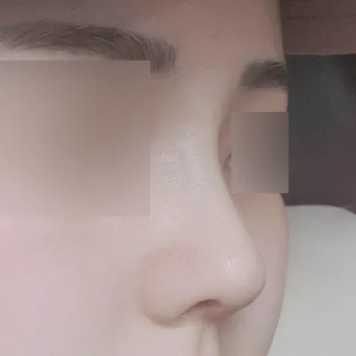 Хамрын мэс засал хийлгэснээс хойш 1 сар болж байна