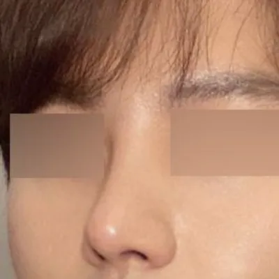 Хамрын гурав дахь хагалгаа / Нүдний анхны хагалгааны дараах сэтгэгдэл