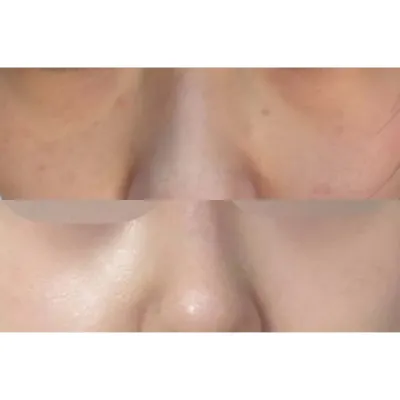 Би Сим Жон Хван эмчийн нүдний доод өөхний нөхөн сэргээх мэс засалд орсон!