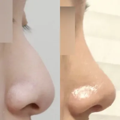 Би хамрын анхны мэс ажилбараа имплантгүйгээр хийлгэсэн!