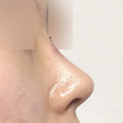 Унжсан хамрын үзүүрт хагалгаа хийлгэсэн