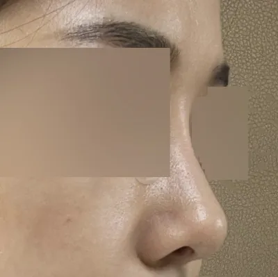 Мэс засал хийлгэснээс хойш 3 сар гаруйн дараах сэтгэгдэл байнаа~