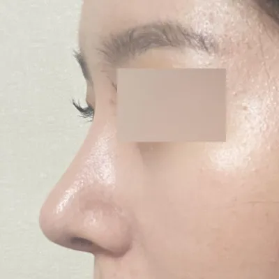 Битүү хамар засварын хагалгааны дараах 2 дахь долоо хоног