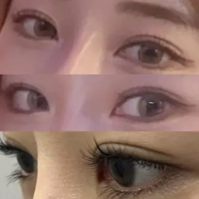 Нүдний мэс засал хийлгэснээс хойш 1 сар өнгөрчээ~~