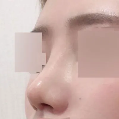 Бөөрөнхий хамартаа дахин хагалгаа хийлгэсэн!