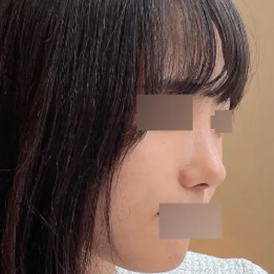 Хамар томруулах мэс засал хийлгэснээс хойш 3 сар боллоо