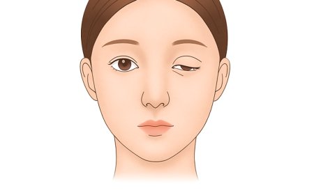 Зовхи унжилт өөрөө оношлох арга ба байгалийн наалдамхай нүдний засал | Нойрмог харагдах нүдийг сайжруулах