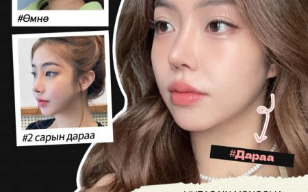 NANA Plastic surgery 🇰🇷 Хамрын мэс засал Нүүрний өөх соруулах мэс заслын дараах бодит өөрчлөлт