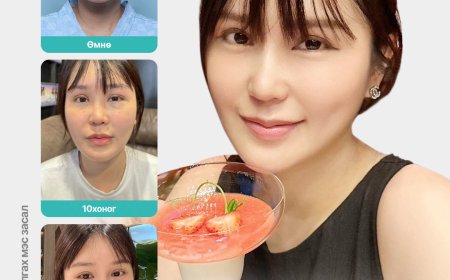 Нүүрэнд өөх суулгах мэс заслын эдгэрэх явц болон үр дүн