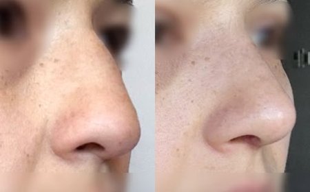 Хамрын мэс засал😍BEFORE & AFTER