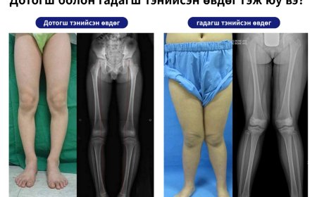 🧑‍⚕️Дотогш болон гадагш тэнийсэн өвдөг гэж юу вэ?
