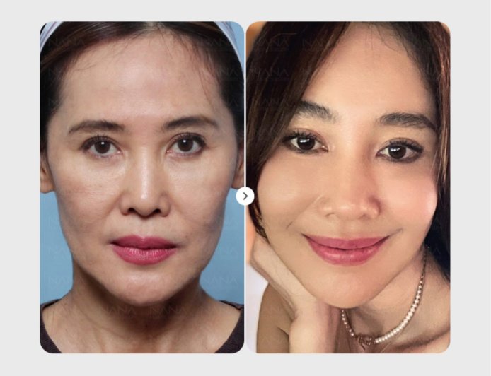 NANA Гоо сайхны эмнэлэгт “Залуужуулах мэс засал”-д орсон үйлчлүүлэгчийн өөрчлөлт