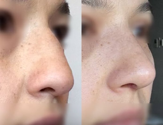 Хамрын мэс засал😍BEFORE & AFTER