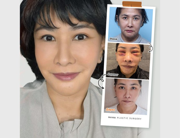 NANA залуужуулах мэс заслын 2 сарын дараах өөрчлөлт