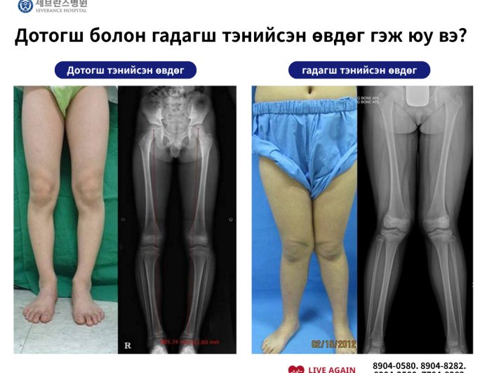 🧑‍⚕️Дотогш болон гадагш тэнийсэн өвдөг гэж юу вэ?