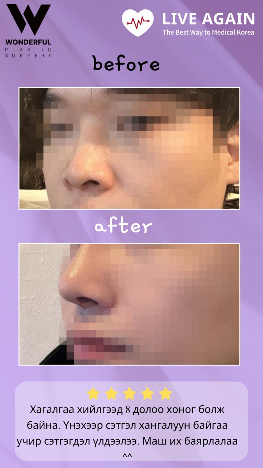 "Wonderful" Гоо сайхны мэс заслын эмнэлэг Before & After Хамрын мэс засал