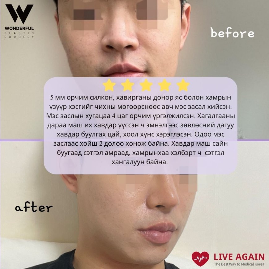 "Wonderful" Гоо сайхны мэс заслын эмнэлэг Before & After Хамрын мэс засал