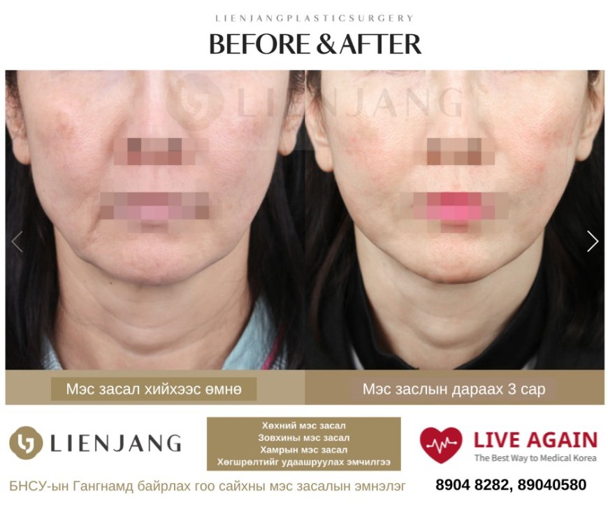 Before & After LIENJANG plastic surgery