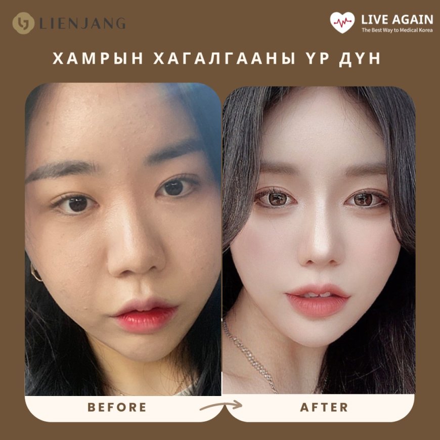 Хамрын мэс засал Before & After