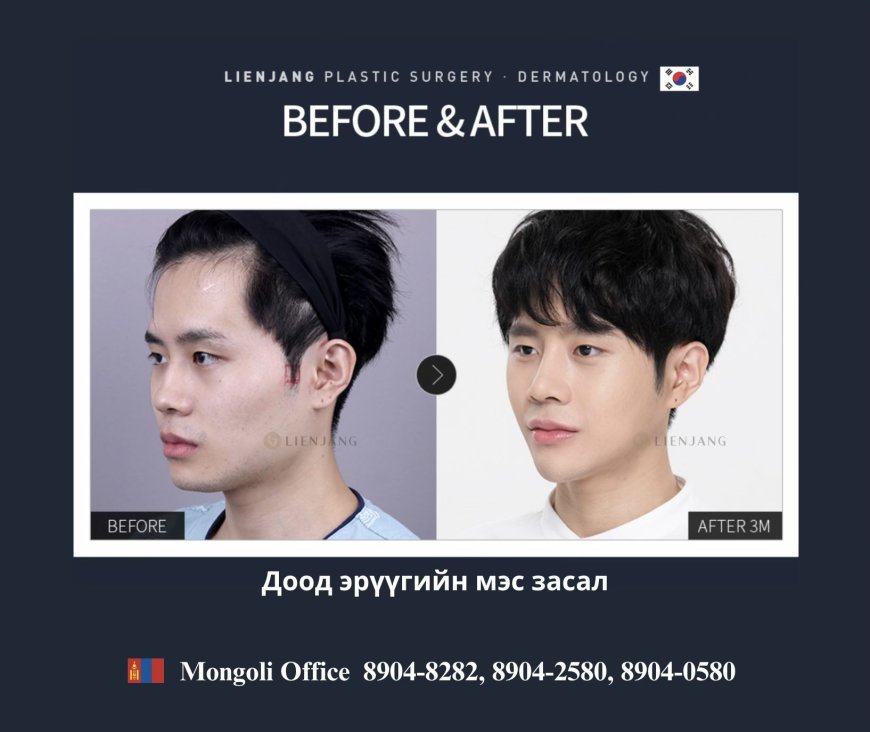 Before & After Доод эрүүний мэс засал