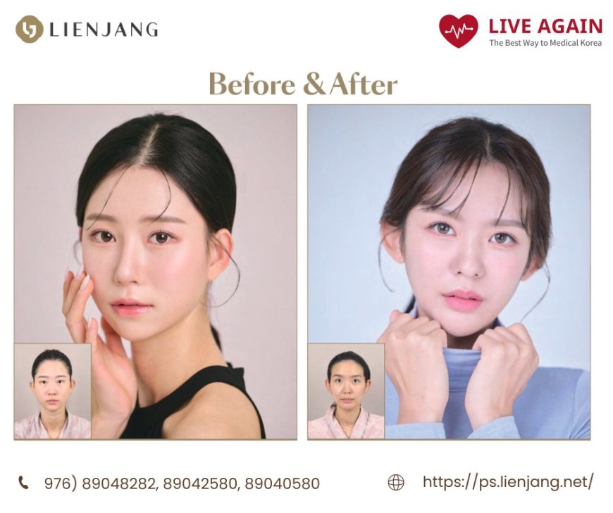 "Lienjang гоо сайхны мэс заслын эмнэлэг" Before & After