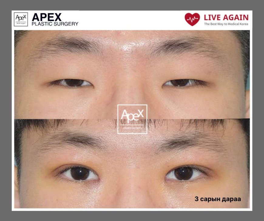 " Apex " Гоо сайхны мэс заслын эмнэлэг  Before & After 