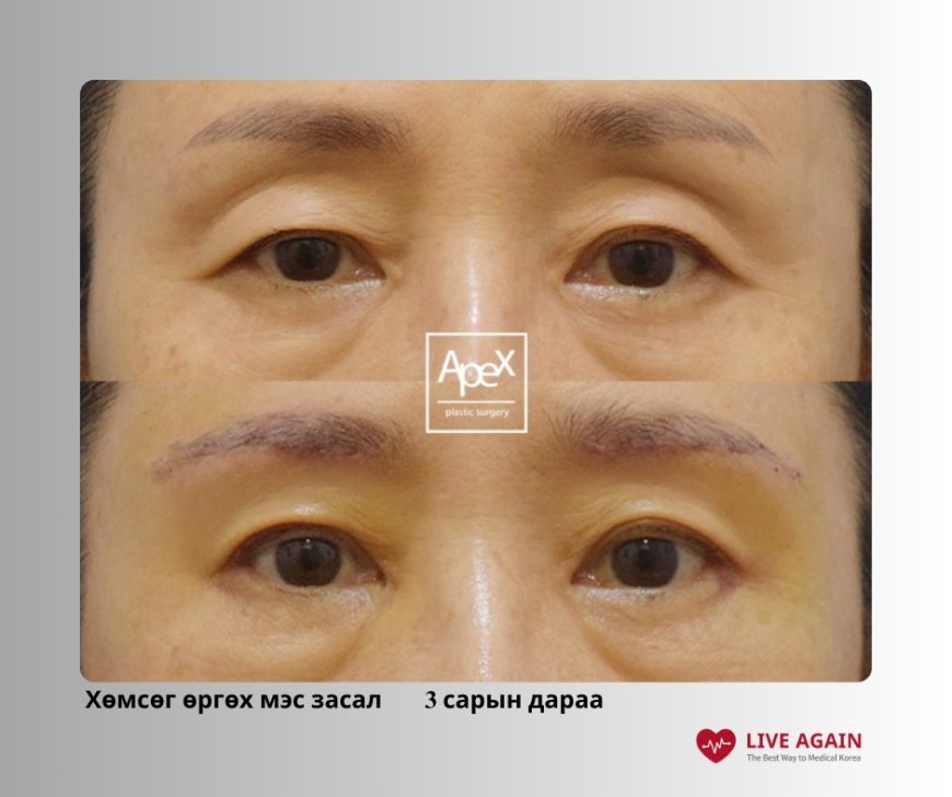 APEX PLASTIC SURGERY 'Хөмсөгний доогуур зүсэлттэй зовхи өргөх мэс засал"