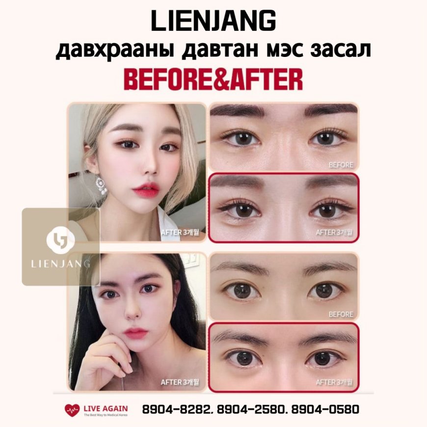 "Lienjang гоо сайхны мэс заслын эмнэлэг"  Давхрааны давтан мэс засал