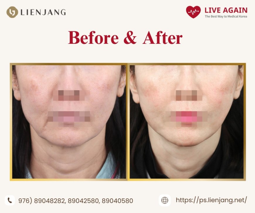 Нүүр өргөх  "Залуужуулах мэс засал" - "Lienjang гоо сайхны мэс заслын эмнэлэг"