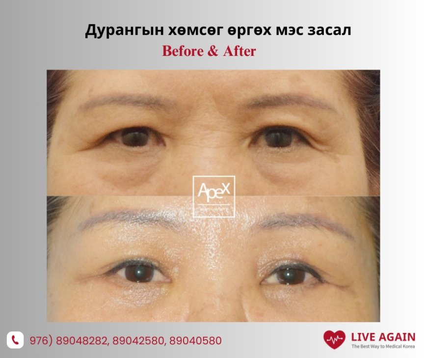 Дурангын хөмсөг өргөх мэс засал "  " Apex " Гоо сайхны мэс заслын эмнэлэг  Before & After 