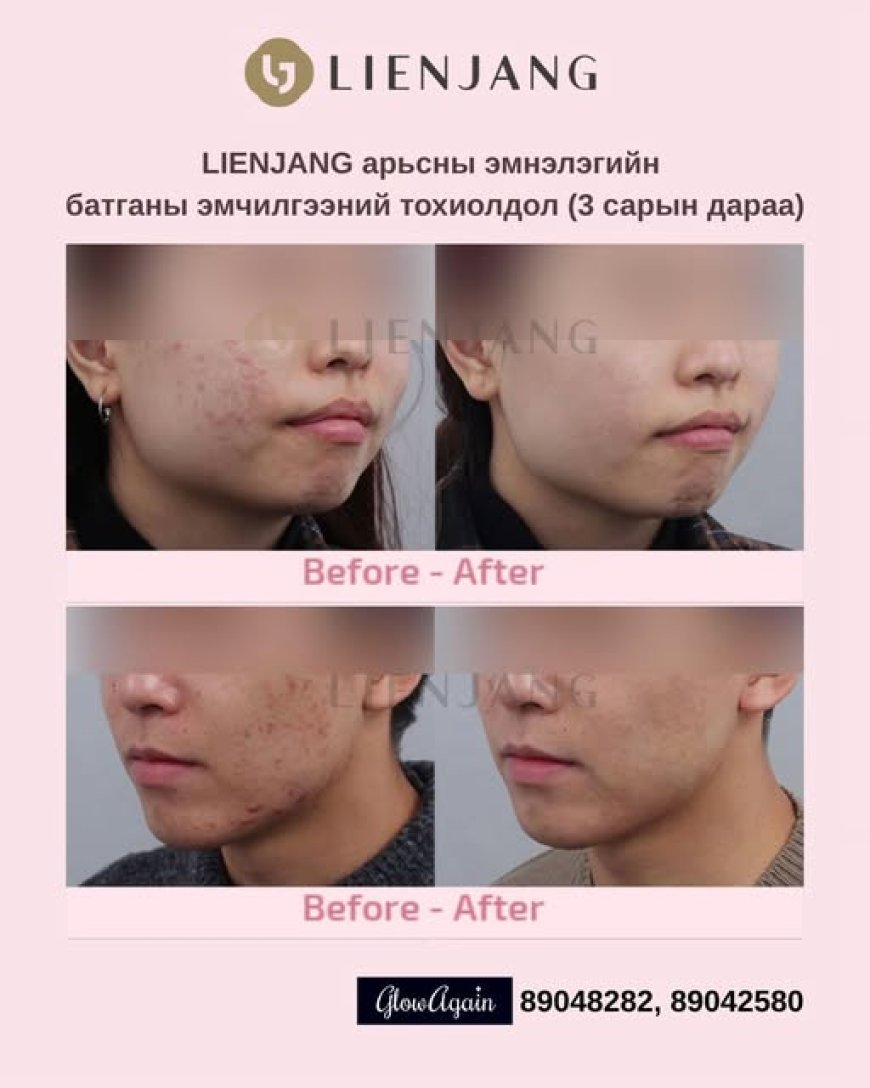 Батганы эмчилгээ , Lienjang арьсны эмнэлэг