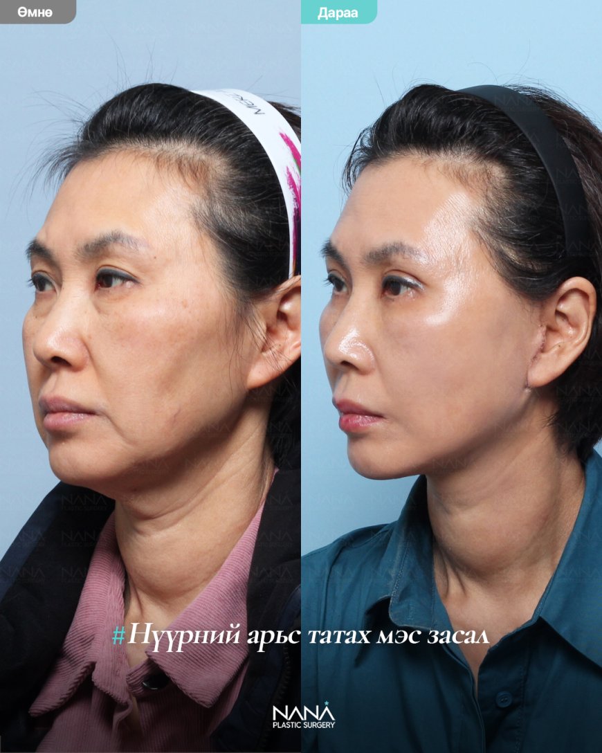 NANA plastic surgery🇰🇷 залуужуулах мэс заслын дараах өөрчлөлт