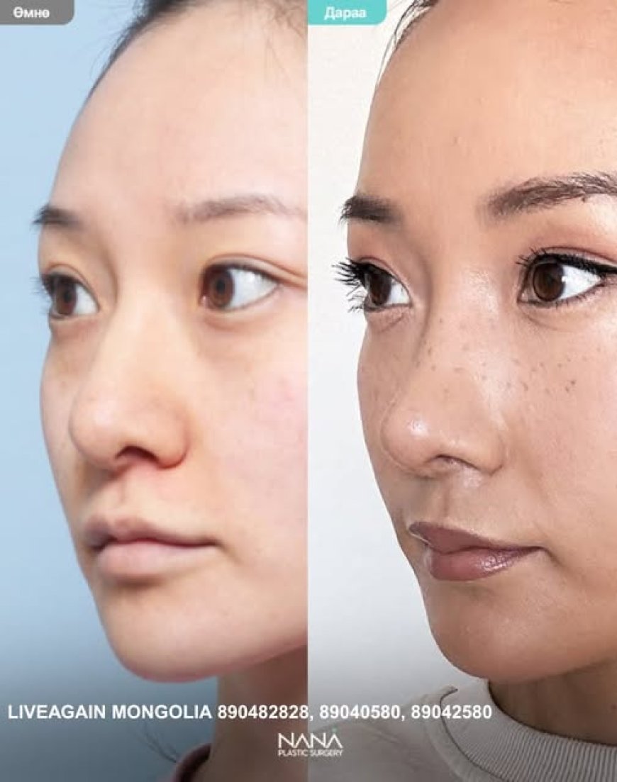 NANA Plastic surgery Хамрын мэс засал