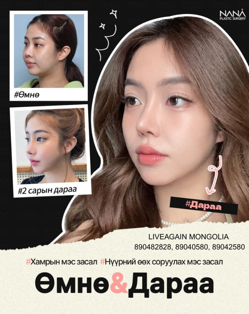 NANA Plastic surgery 🇰🇷 Хамрын мэс засал Нүүрний өөх соруулах мэс заслын дараах бодит өөрчлөлт