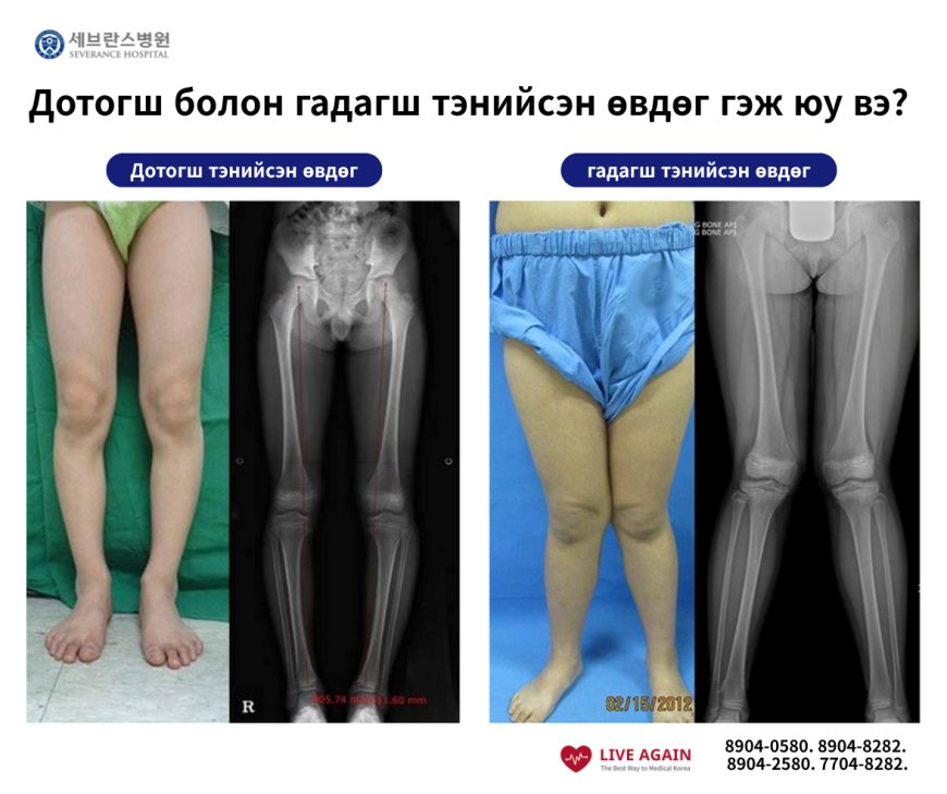 🧑⚕️Дотогш болон гадагш тэнийсэн өвдөг гэж юу вэ?